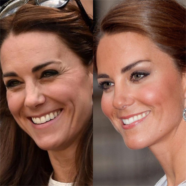 Botox Miracles